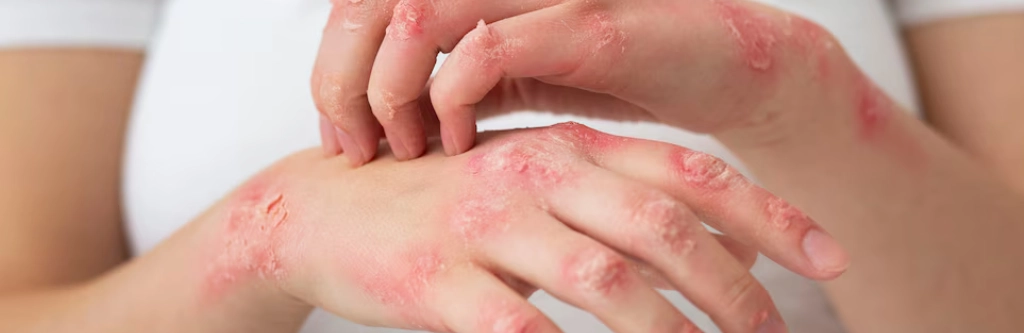 Eczema