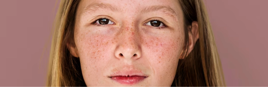 Hyperpigmentation