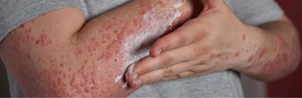 best cosmetologist in chennai Psoriasis