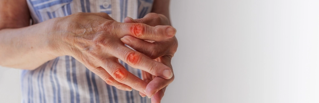 Rheumatoid Arthritis