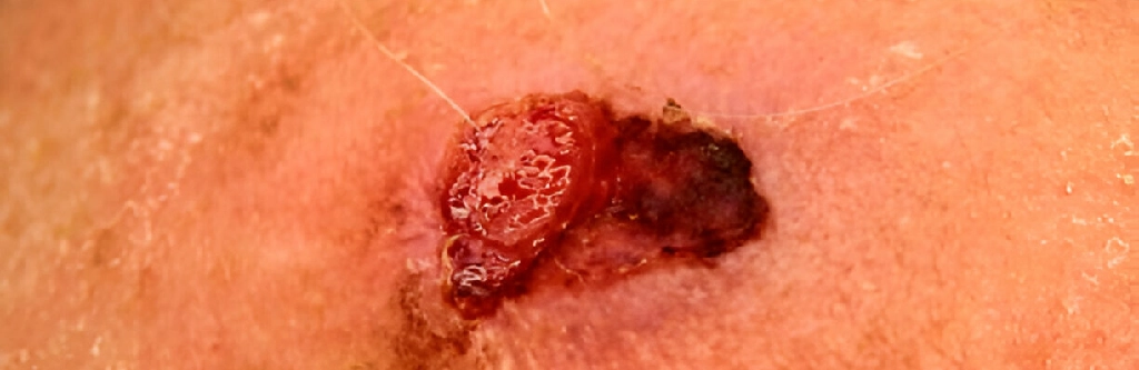 Squamous Cell Carcinoma