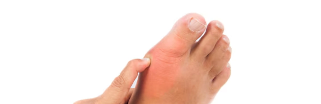 Plantar Fasciitis