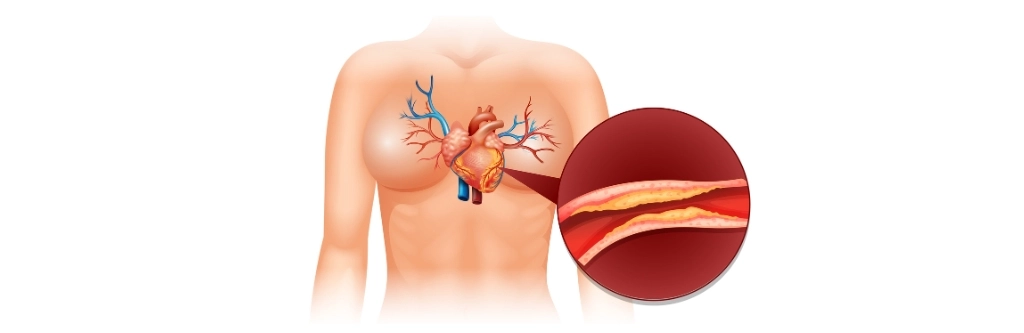 Coronary Artery Disease (CAD)