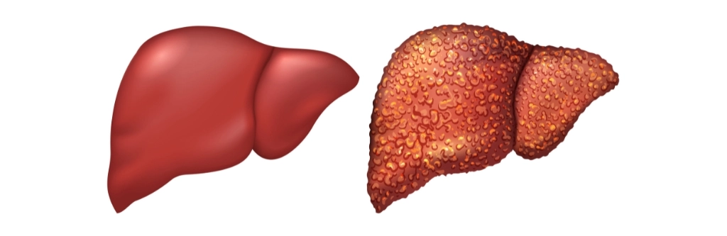 Fatty Liver Disease