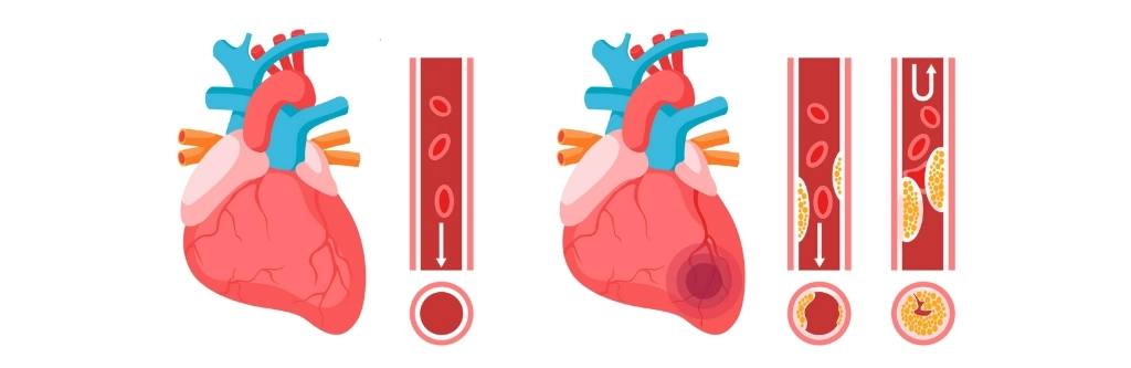 cardiac anaesthesiologist in chennai, Heart Failure