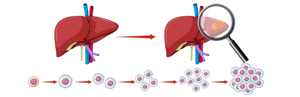 Hepatitis