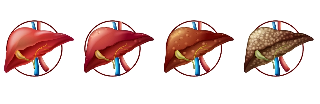 liver specialist in chennai, Liver Cirrhosis