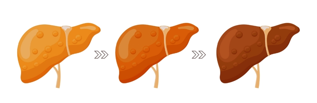 Liver Fibrosis