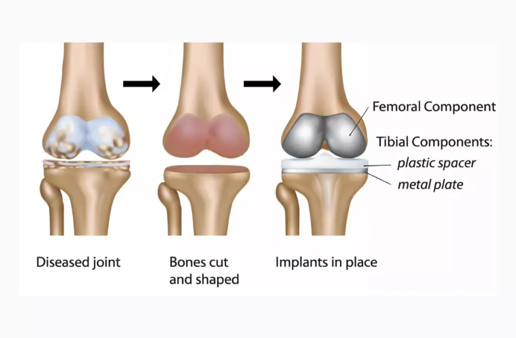 Best Orthopedic Hospitals in Chennai