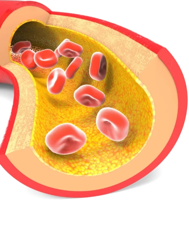 Cholesterol Management