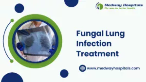 Fungal lung infection treatment | Medway Hospitals