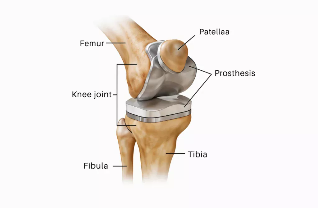 Knee Replacement Surgery Cost in Chennai