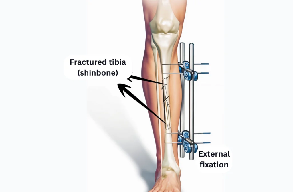Limb Lengthening Surgery in Chennai