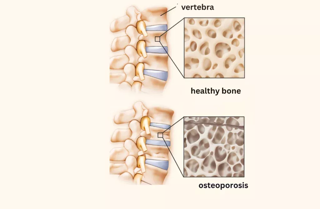 Bone Health in Women