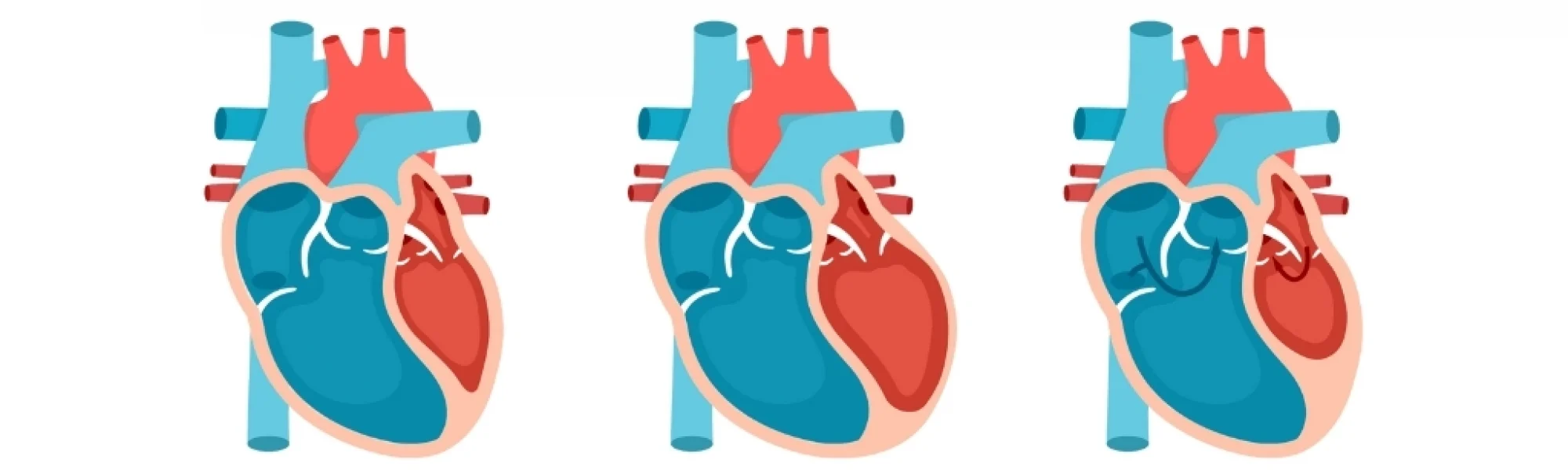 pediatric arrhythmias treatment