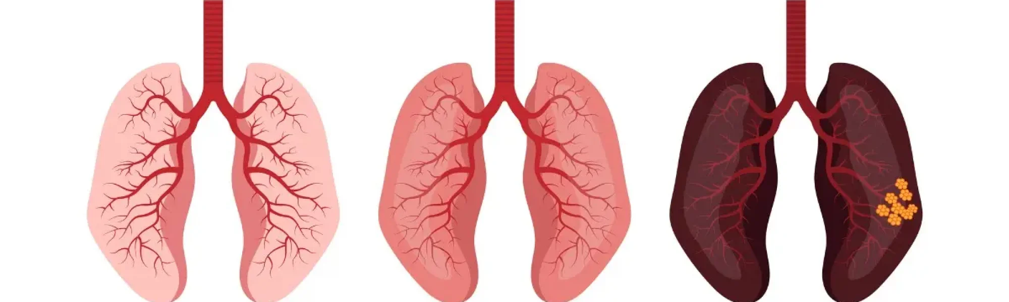 Lung cancer treatment in Chennai